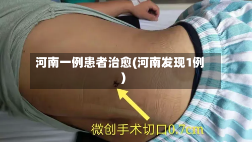 河南一例患者治愈(河南发现1例)