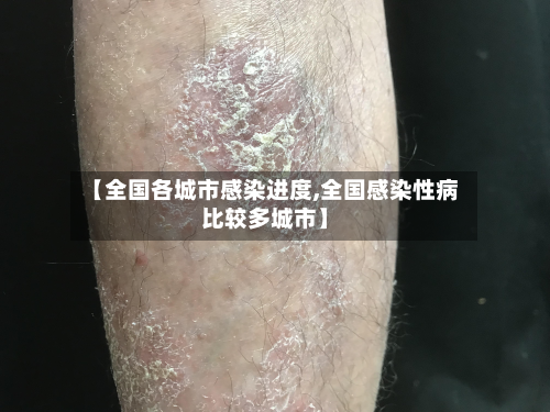 【全国各城市感染进度,全国感染性病比较多城市】-第3张图片